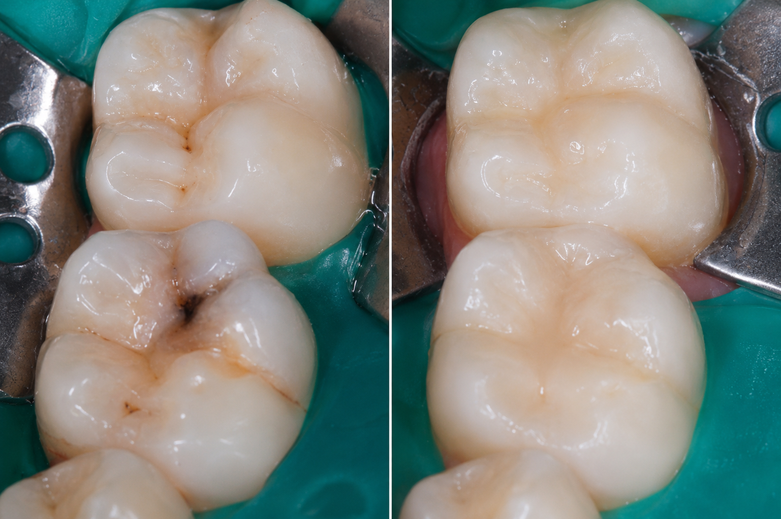 Are Tooth Colored Fillings Strong Enough for Back Teeth - Humber Dental