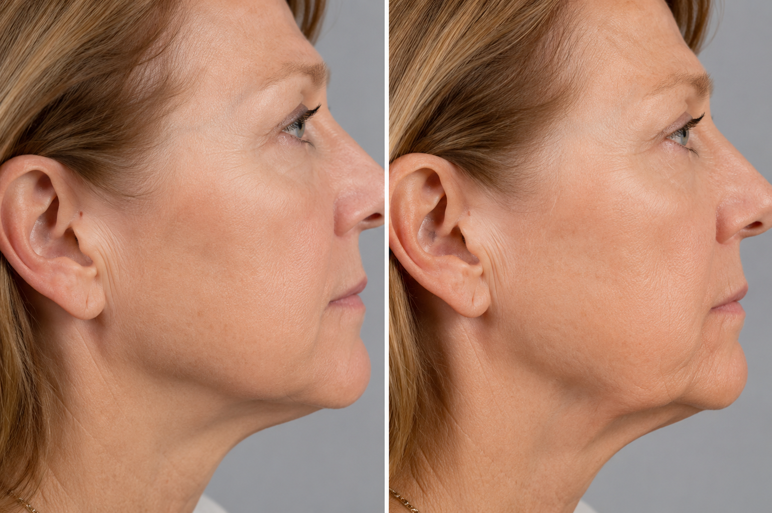 Jaw bone loss after teeth loss - Humber Dental