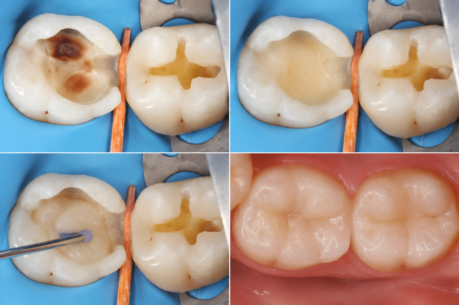 Tooth Colored Fillings in Etobicoke - Humber Dental