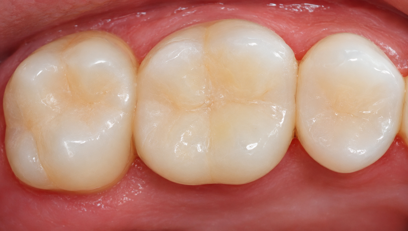 Composite resign filling - Humber Dental